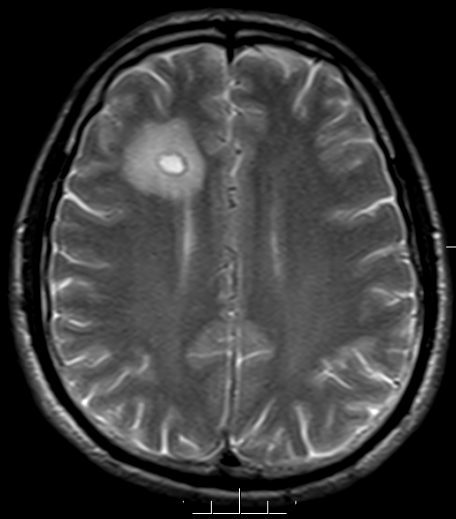 Brain_MRI_131716_T2.png